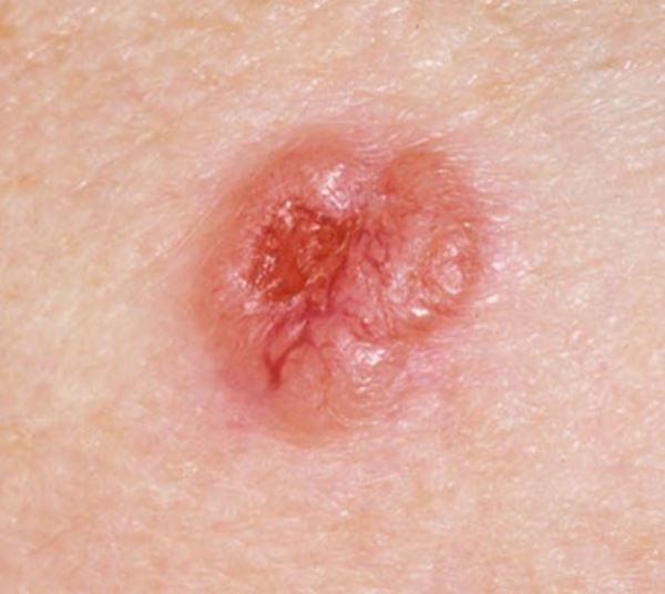 Carcinoma Basocelular